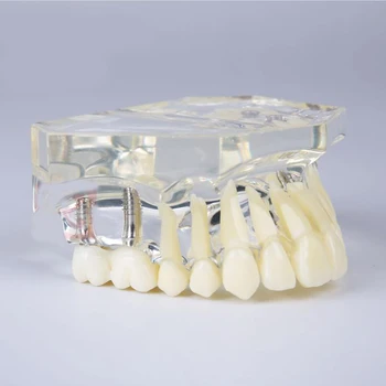 M2011 Implantas Žandikaulio Modelį, Dantų, Dantų Modelis