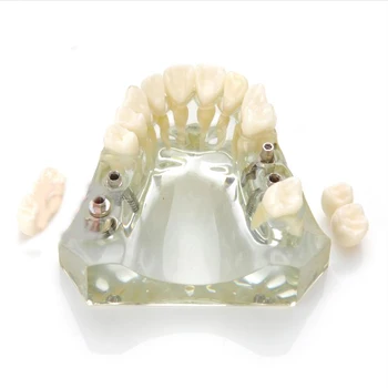 M2011 Implantas Žandikaulio Modelį, Dantų, Dantų Modelis Nuotrauka 2